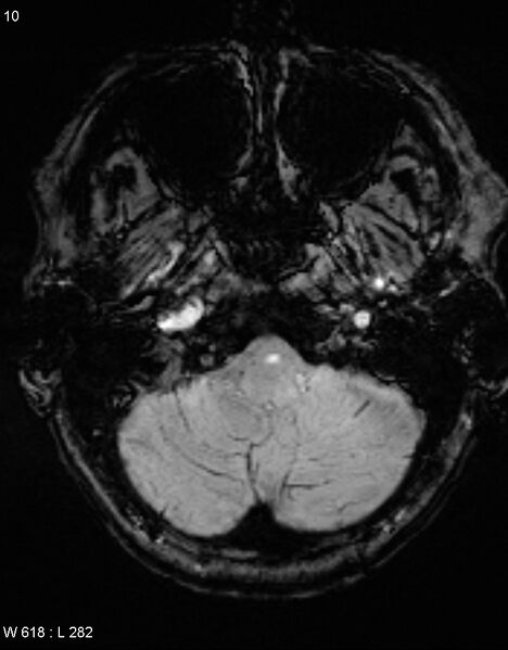 File:Chronic lymphocytic inflammation with pontine perivascular enhancement responsive to steroids (CLIPPERS) (Radiopaedia 37520-39374 Axial SWI 9).jpg