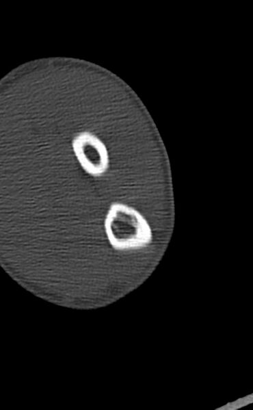 File:Chronic osteomyelitis of the distal humerus (Radiopaedia 78351-90971 Axial bone window 114).jpg