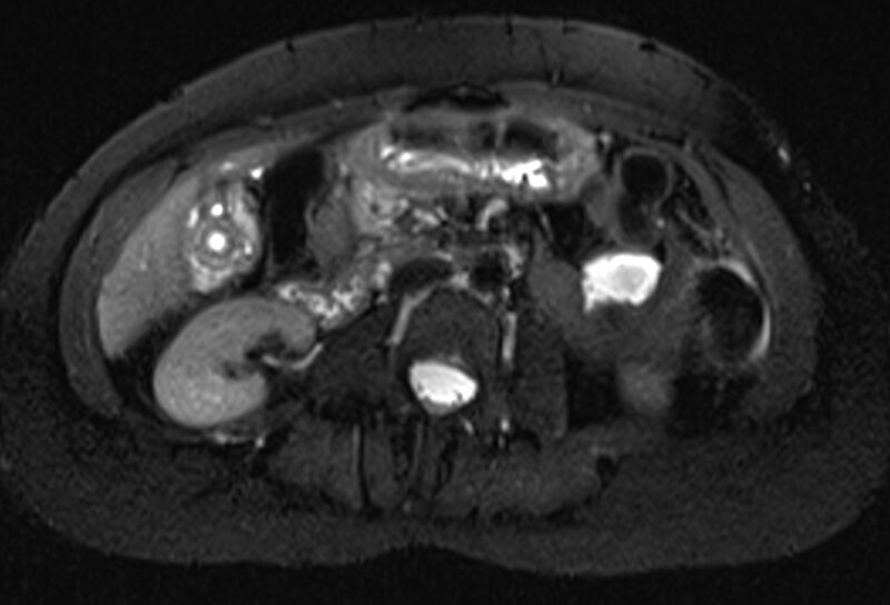 File:Chronic pancreatitis - pancreatic duct calculi (Radiopaedia 71818-82250 Axial T2 fat sat 39).jpg