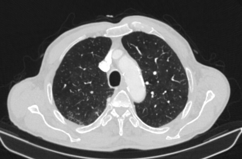 File:Chronic pulmonary embolism (Radiopaedia 91241-108843 Axial lung window 22).jpg