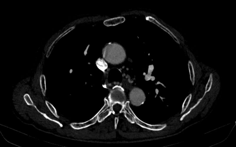 File:Chronic pulmonary embolism (Radiopaedia 91241-108843 B 67).jpg