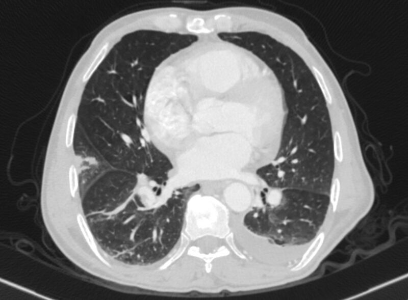 File:Chronic pulmonary embolism with bubbly consolidation (Radiopaedia 91248-108850 Axial lung window 98).jpg