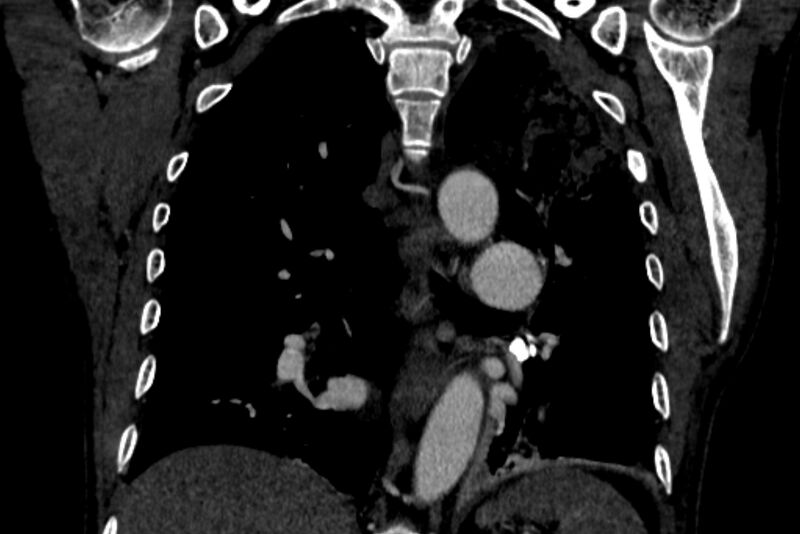File:Chronic pulmonary embolism with bubbly consolidation (Radiopaedia 91248-108850 B 91).jpg