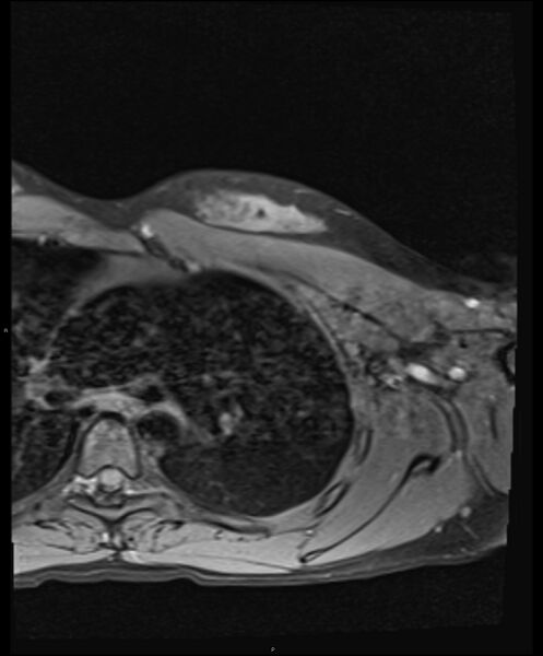 File:Chronic reactive multifocal osteomyelitis (CRMO) - clavicle (Radiopaedia 56406-63114 Axial T1 fat sat 21).jpg