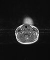 Chronic reactive multifocal osteomyelitis (CRMO) - mandible (Radiopaedia 56405-63069 Axial T1 2).jpg