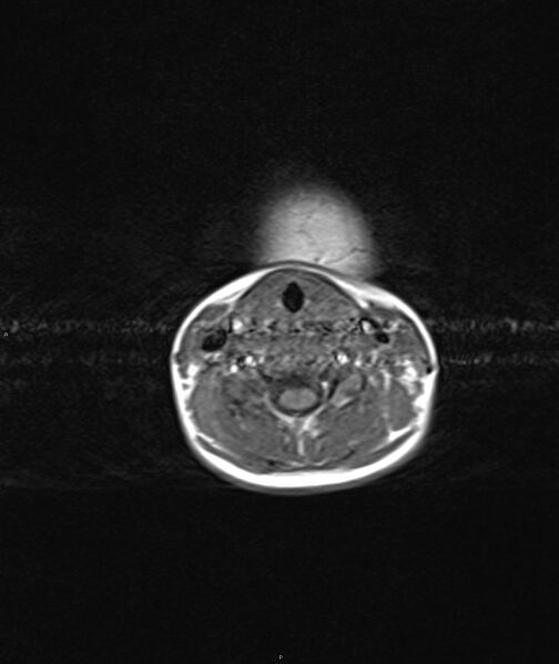 File:Chronic reactive multifocal osteomyelitis (CRMO) - mandible (Radiopaedia 56405-63069 Axial T1 2).jpg