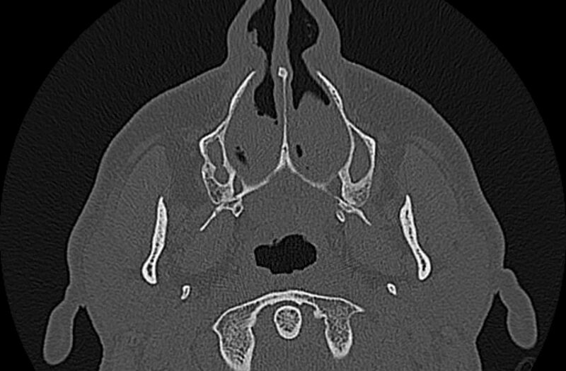File:Chronic rhinosinusitis (Radiopaedia 65079-74075 Axial bone window 10).jpg