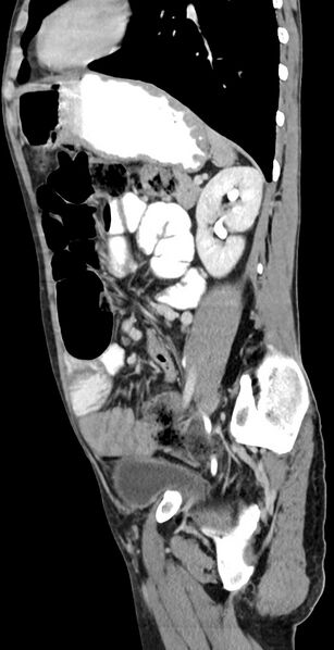 File:Chronic small bowel volvulus (Radiopaedia 75224-86322 C 53).jpg