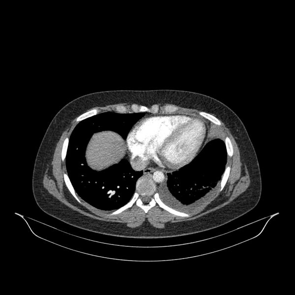 File:Chronic thromboembolic pulmonary hypertension (CTEPH) (Radiopaedia 74597-85532 Axial C+ CTPA 52).jpg