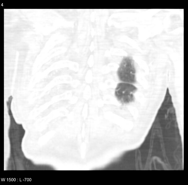 File:Clagett thoracotomy (Radiopaedia 8568-9403 Coronal lung window 4).jpg