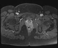 Class II Mullerian duct anomaly- unicornuate uterus with rudimentary horn and non-communicating cavity (Radiopaedia 39441-41755 Axial T1 fat sat 120).jpg
