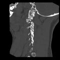 Clay-shoveler fracture (Radiopaedia 22568-22590 Sagittal bone window 5).jpg