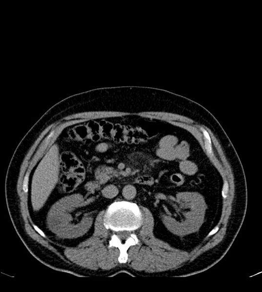 File:Clear cell renal cell carcinoma (Radiopaedia 85006-100539 Axial non-contrast 37).jpg