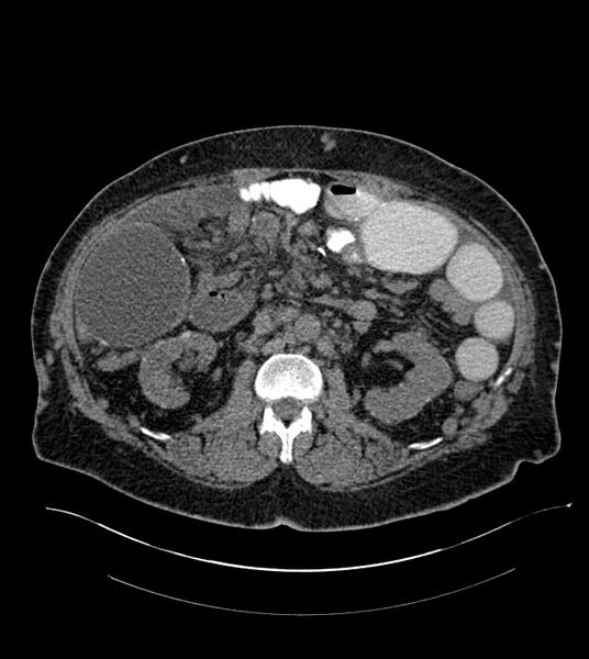 File:Closed-loop small bowel obstruction-internal hernia (Radiopaedia 78439-91096 Axial non-contrast 69).jpg