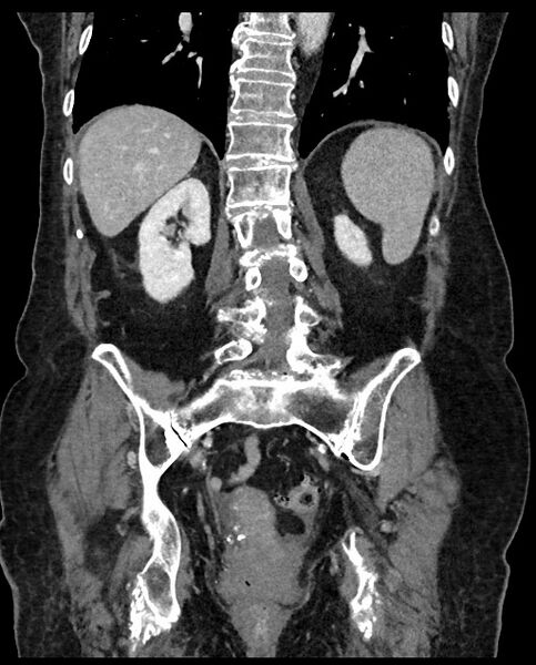 File:Closed loop small bowel obstruction - adhesions (Radiopaedia 59269-66611 B 88).jpg
