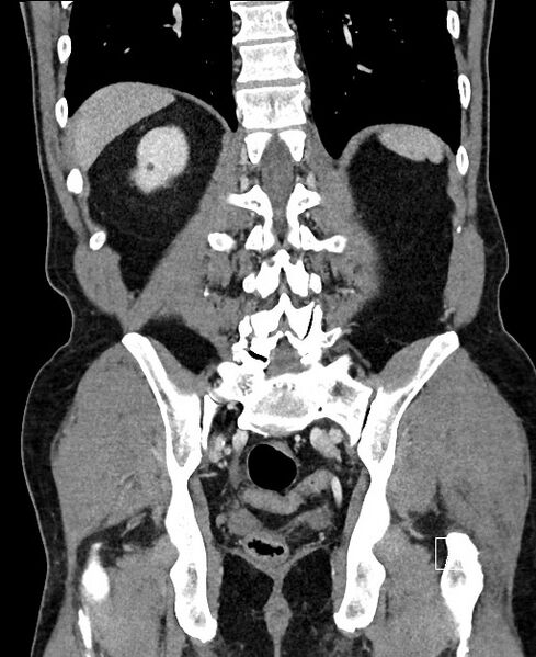 File:Closed loop small bowel obstruction - internal hernia (Radiopaedia 57806-64778 A 89).jpg