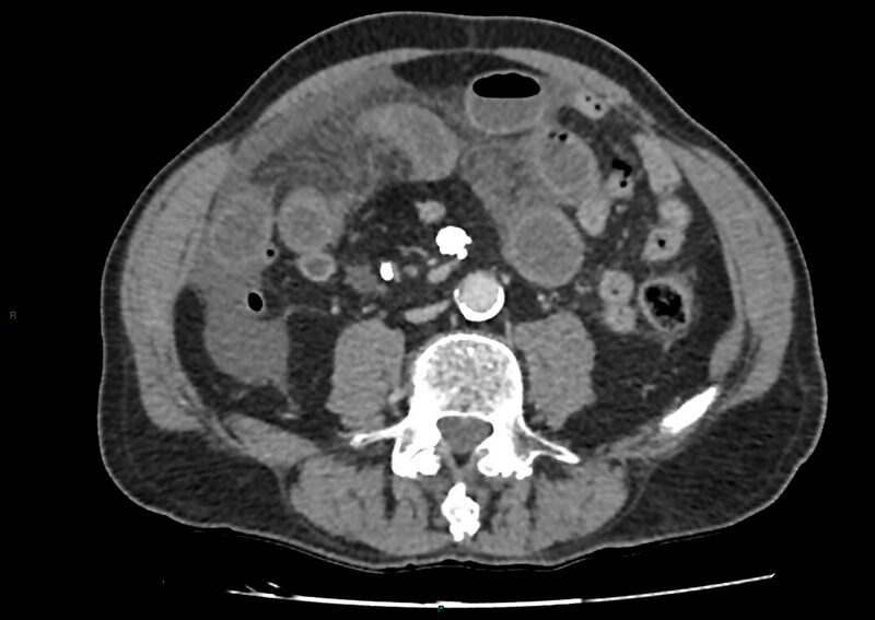 File:Closed loop small bowel obstruction with ischemia (Radiopaedia 84180-99456 A 68).jpg
