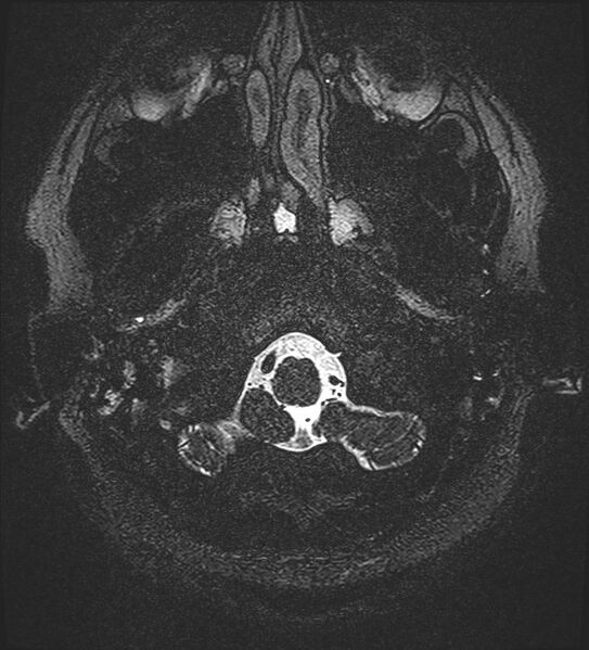 File:Cochlear incomplete partition type III associated with hypothalamic hamartoma (Radiopaedia 88756-105498 Axial T2 12).jpg