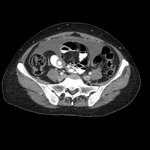 File:Cocoon abdomen with possible tubo-ovarian abscess (Radiopaedia 46235-50636 A 32).png