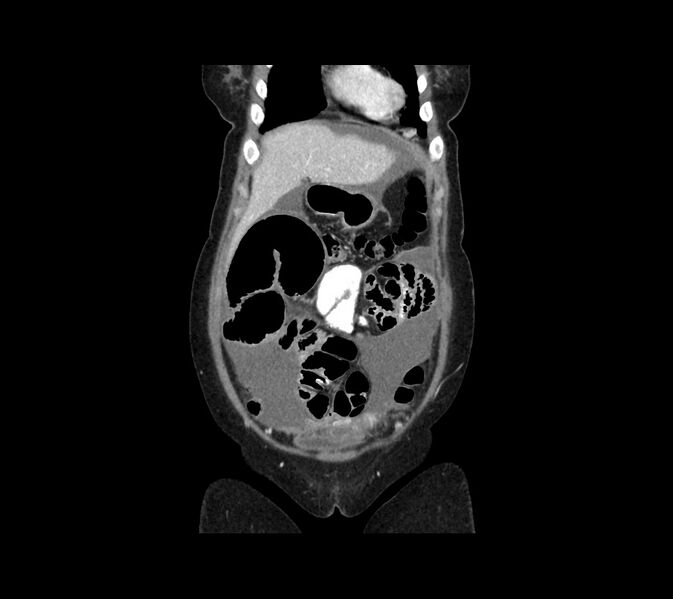 File:Cocoon abdomen with possible tubo-ovarian abscess (Radiopaedia 46235-50636 B 11).jpg