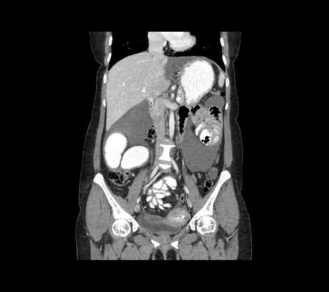 File:Cocoon abdomen with possible tubo-ovarian abscess (Radiopaedia 46235-50636 B 26).jpg
