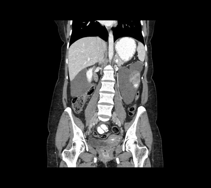 File:Cocoon abdomen with possible tubo-ovarian abscess (Radiopaedia 46235-50636 B 31).jpg