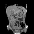 Colocolic fistula - Crohn disease (Radiopaedia 57063-63955 B 14).jpg
