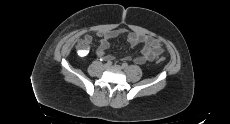 File:Colocutaneous fistula (Radiopaedia 56401-63062 Axial Fistulography 26).jpg