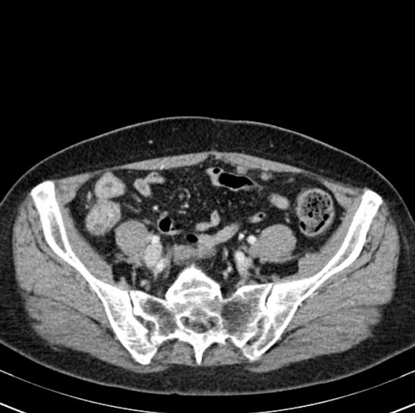 File:Colon carcinoma with hepatic metastases (Radiopaedia 29477-29961 A 86).jpg