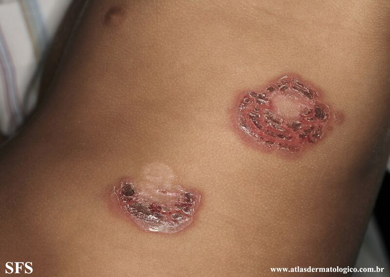 File:Impetigo (Dermatology Atlas 85).jpg