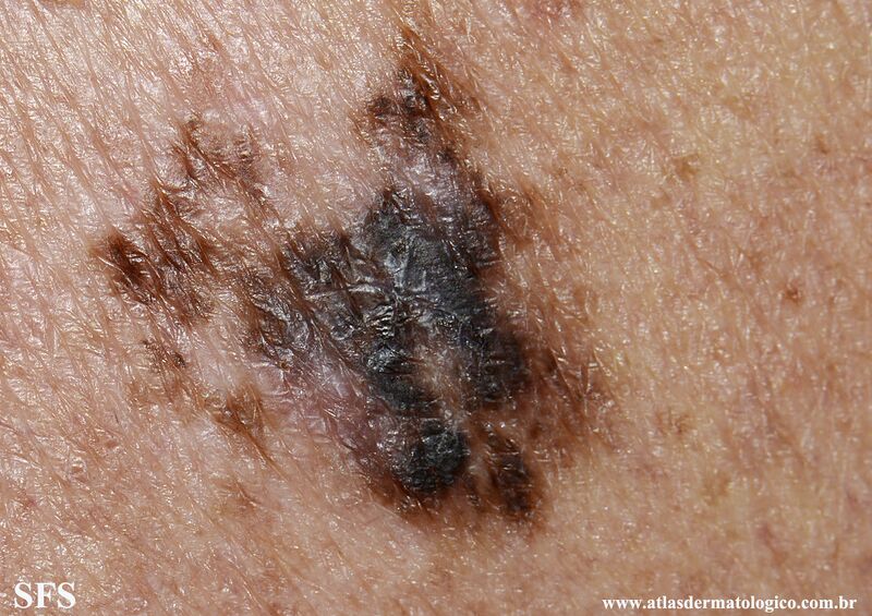 File:Melanoma (Dermatology Atlas 118).jpg