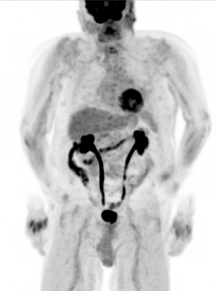 File:Motion artifact on PET-CT (Radiopaedia 72465).PNG