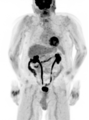 Motion artifact on PET-CT (Radiopaedia 72465).PNG