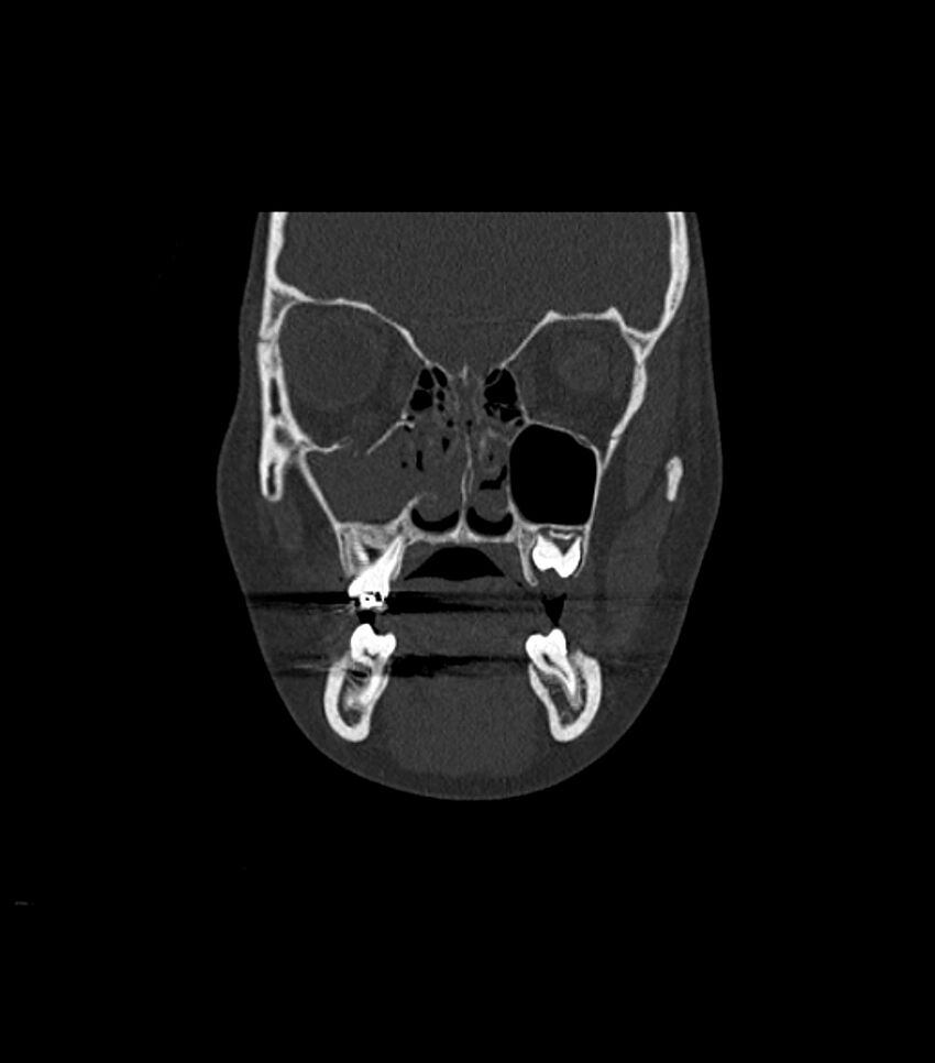 Nasoorbitoethmoid fracture (Radiopaedia 90044-107205 Coronal bone window 50).jpg