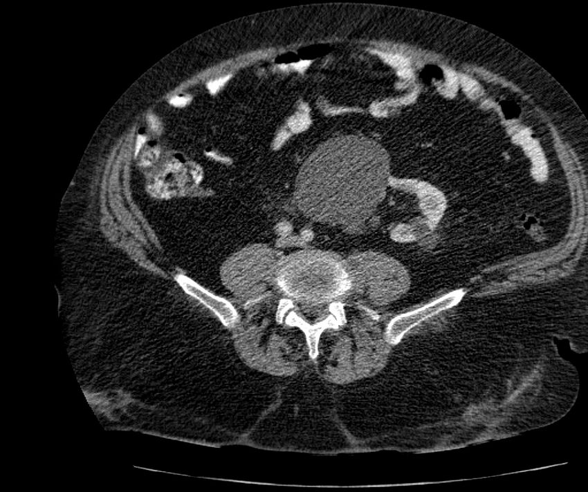 Nephroptosis with inguinal hernia containing perirenal fat (Radiopaedia 56632-63391 C 222).jpg