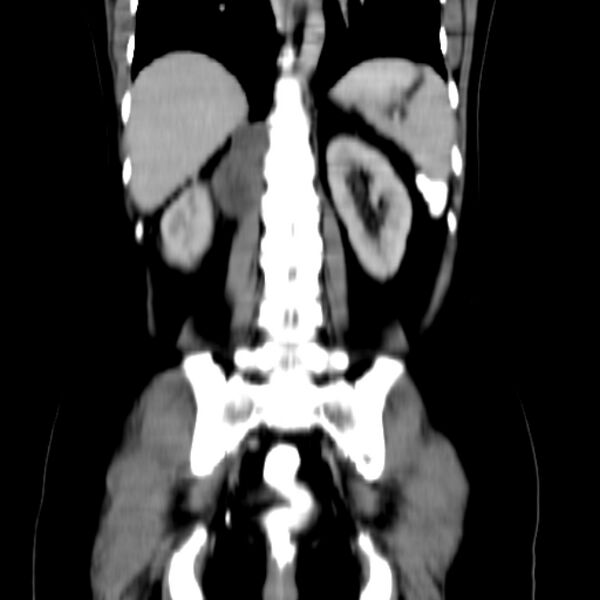 File:Neurofibroma - spine (Radiopaedia 27891-28125 B 21).jpg