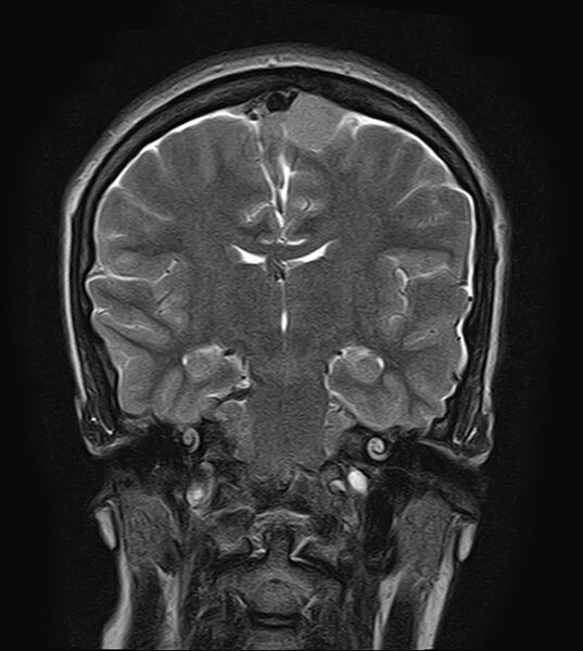 File:Neurofibromatosis type 2 (Radiopaedia 66211-75401 Coronal T2 13).jpg