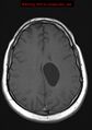 Neuroglial cyst (Radiopaedia 10713-11184 Axial T1 8).jpg