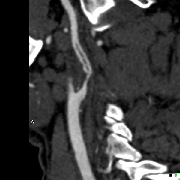 File:Non-occlusive intraluminal internal carotid artery thrombus (Radiopaedia 37751-39658 A 59).jpg