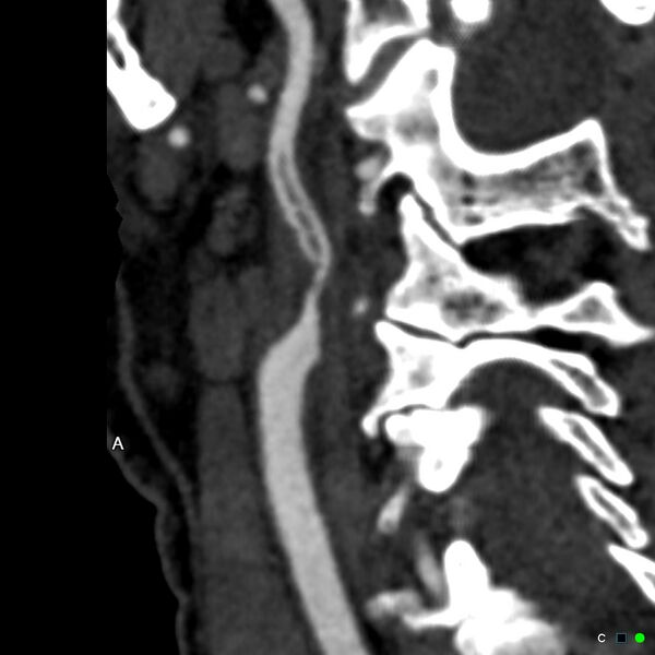 File:Non-occlusive intraluminal internal carotid artery thrombus (Radiopaedia 37751-39658 A 64).jpg