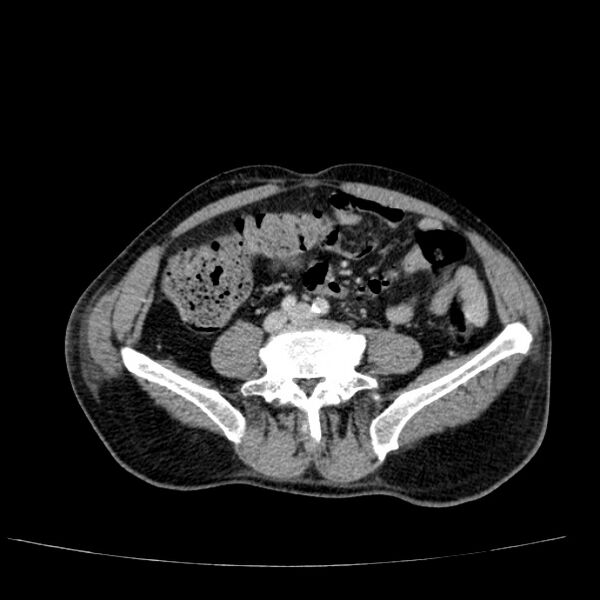 File:Non small-cell lung cancer (Radiopaedia 24467-24769 C+ delayed 90).jpg