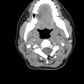 Normal CT of the neck (Radiopaedia 14575-14500 Axial C+ 28).jpg
