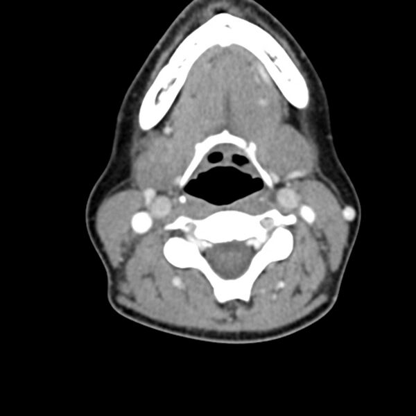 File:Normal CT of the neck (Radiopaedia 14575-14500 Axial C+ 37).jpg
