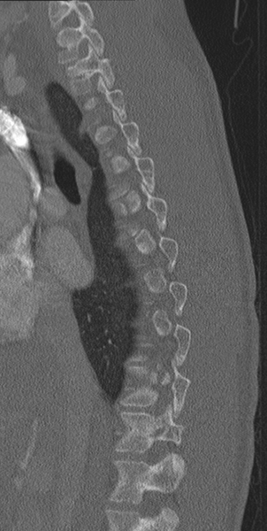 File:Normal CT thoracic spine (Radiopaedia 40181-42688 Sagittal bone window 44).png