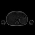 Normal MRI abdomen in pregnancy (Radiopaedia 88001-104541 Axial T2 9).jpg