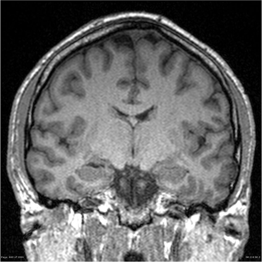Normal brain MRI (non-focal epilepsy protocol) (Radiopaedia 38571-40700 Coronal T1 56).jpg