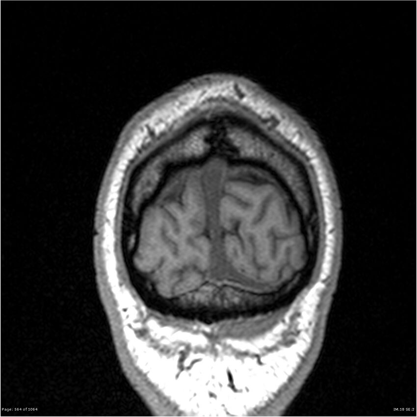 Normal brain MRI (non-focal epilepsy protocol) (Radiopaedia 38571-40700 Coronal T1 8).jpg