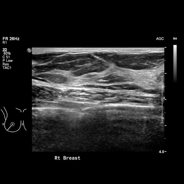 File:Normal breast mammography (tomosynthesis) and ultrasound (Radiopaedia 65325-74354 Right breast 9).jpeg