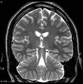 Normal coronal brain (Radiopaedia 6676-7910 Coronal T2 27).jpg