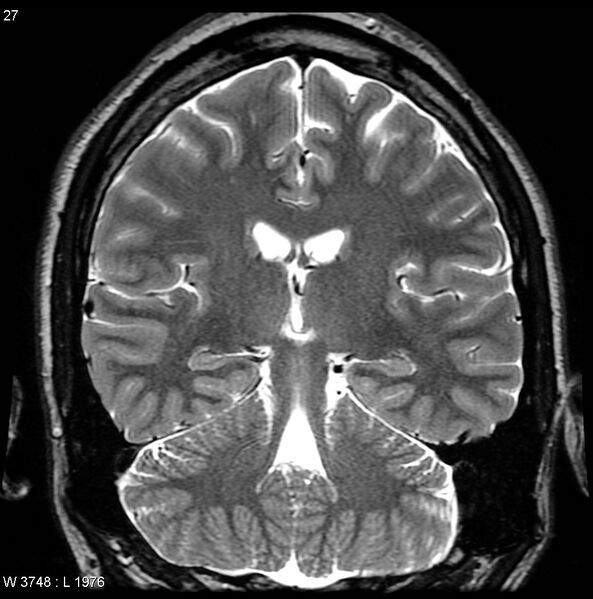 File:Normal coronal brain (Radiopaedia 6676-7910 Coronal T2 27).jpg
